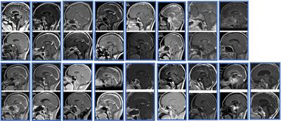 Surgical Outcomes of Clival Chordoma Through Endoscopic Endonasal Approach: A Single-Center Experience